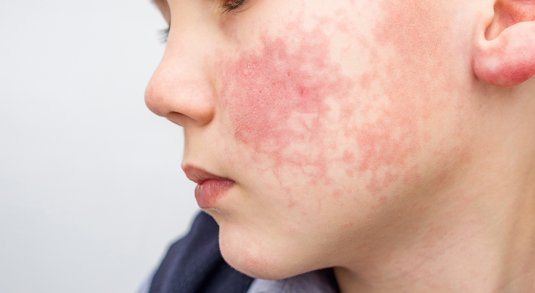 Hand-Fuß-Mund-Krankheit: Symptome und Behandlung