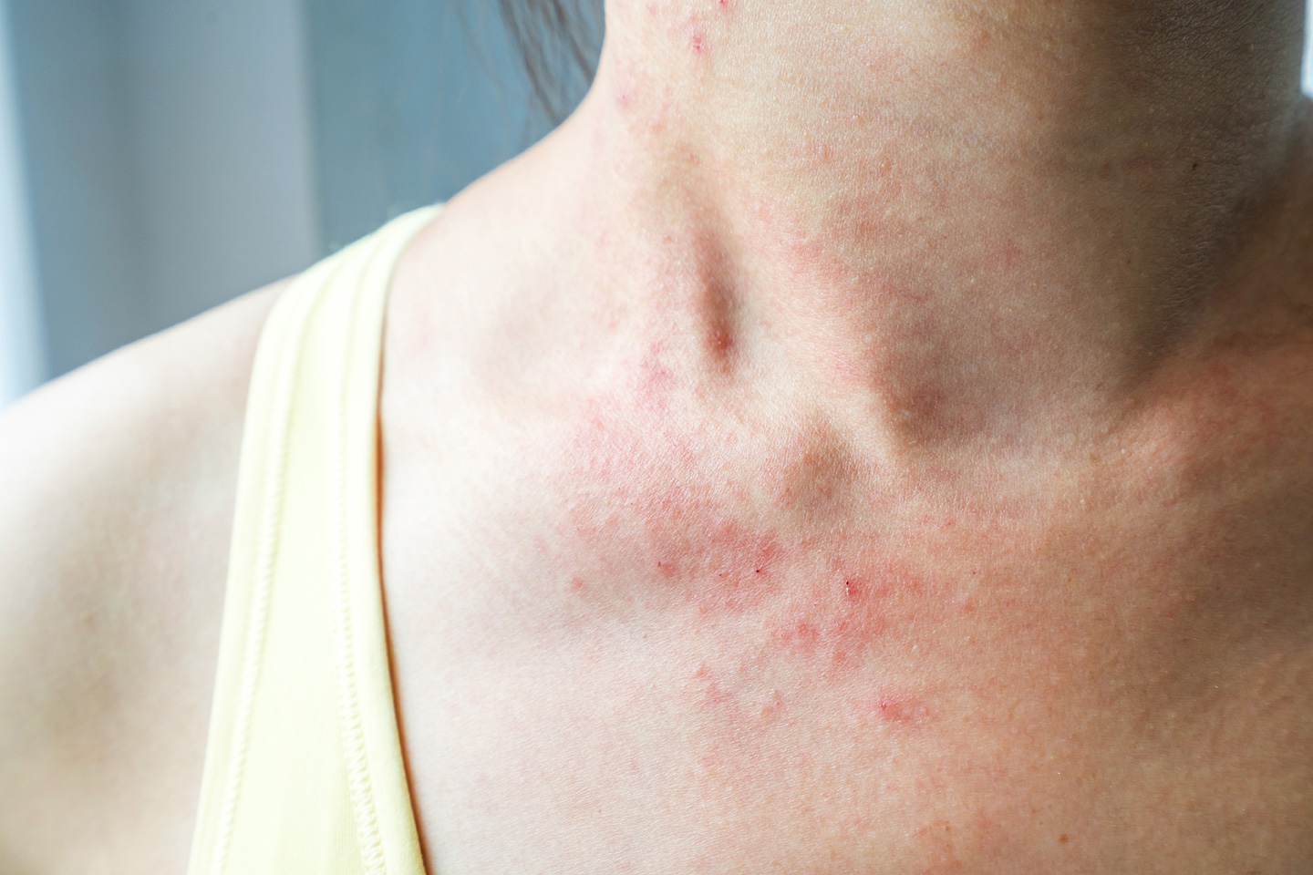 Vitiligo: weiße Flecken auf der Haut