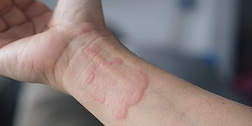 Nesselsucht Ein Unterarm mit rötlichen Quaddeln.