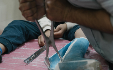 Auf einer Liege sieht man, wie ein Gips vom Kindesfuß getrennt mit einer Gipsschere aufgeschnitten wird.