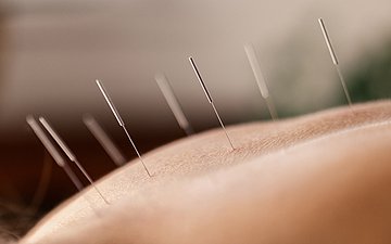 Eine Körperstelle wird mit Akupunktur behandelt.