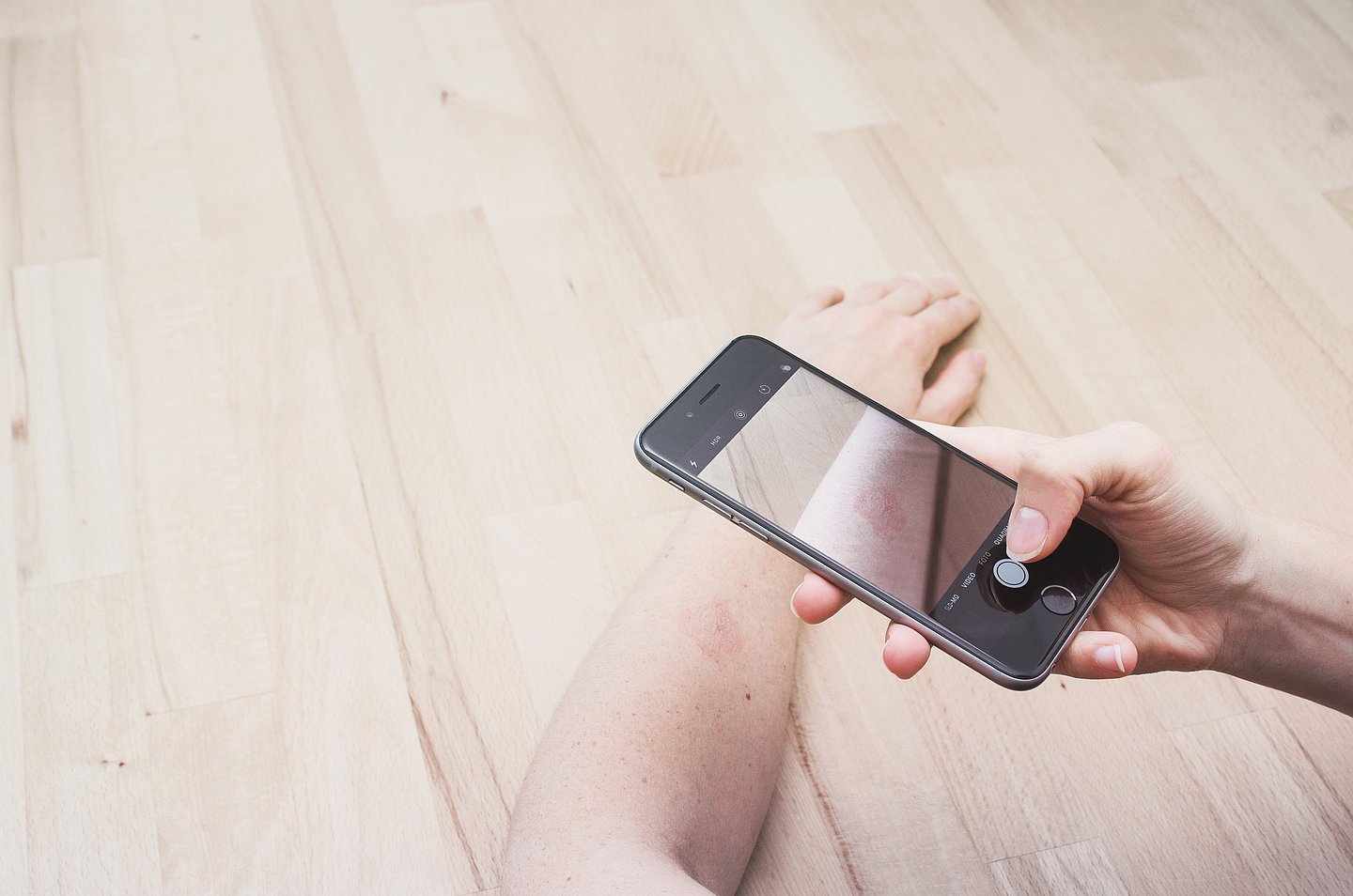 Mittels einer App wird ein Smartphone für ein Hautscreening benutzt.