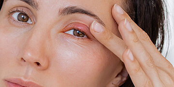 Eine Frau hat ein stark angeschwollenes, rotes Augenlid, an das sie sich fasst.