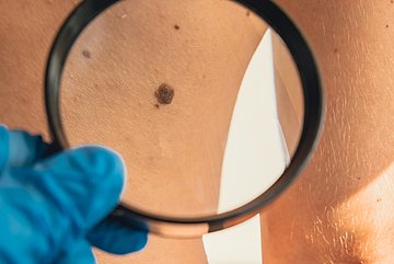 Hautkrebs-Screening in Westfalen-Lippe Eine Hand in Großaufnahme hält eine Lupe, die ein Muttermal vergrößert.