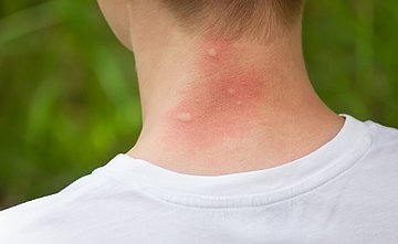 Insektenstiche in Westfalen-Lippe Das Foto zeigt den Nacken einer wahrscheinlich männlichen Person, auf dem diverse Einstiche von Insekten zu sehen sind, die rötlich und leicht geschwollen aussehen.
