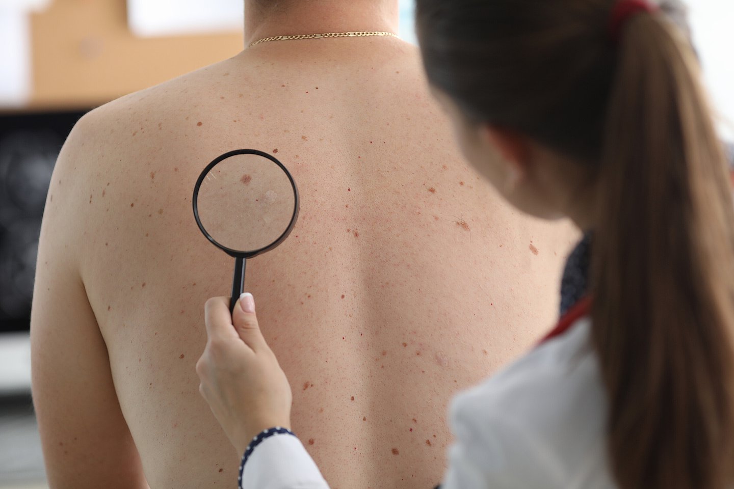 Ärztin prüft Muttermale eines Mannes mit der Lupe