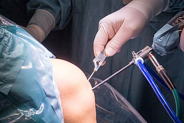 Ärzte operieren ein Knie in Nahaufnahme.