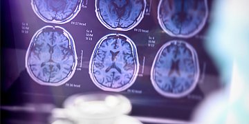 MRT-Bild mit sechs Aufnahmen eines Gehirns.