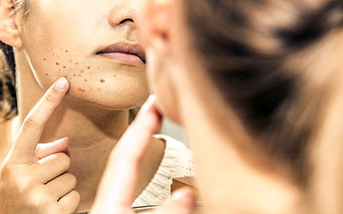 Eine Person betrachtet im Spiegel ihre Akne.