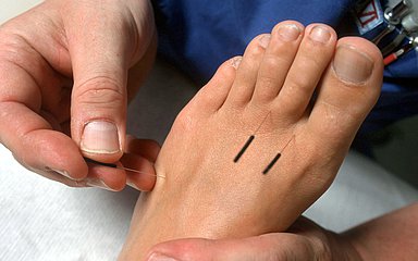 Foto: Behandlung eines Fußes mit Akupunktur-Nadeln.