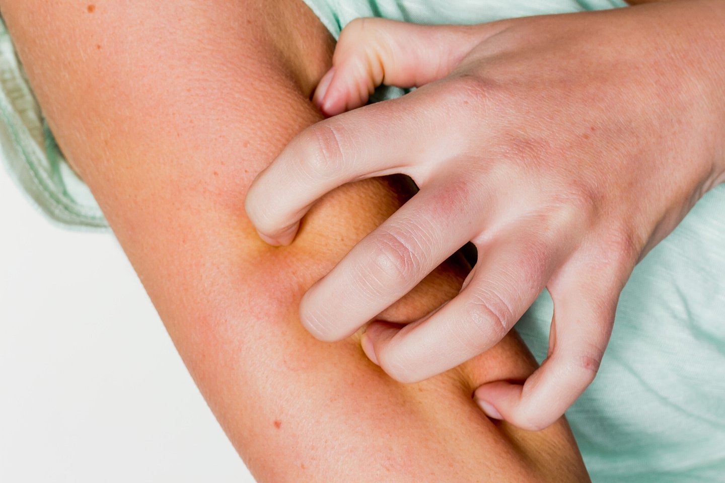 Eine Hand kratzt ein einer juckenden Insekten-Einstichstelle am Arm.