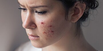 Das Foto zeigt das Gesicht einer jungen Frau mit Akne auf der linken Wange