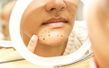 Eine Person betrachtet im Spiegel ihre Akne.