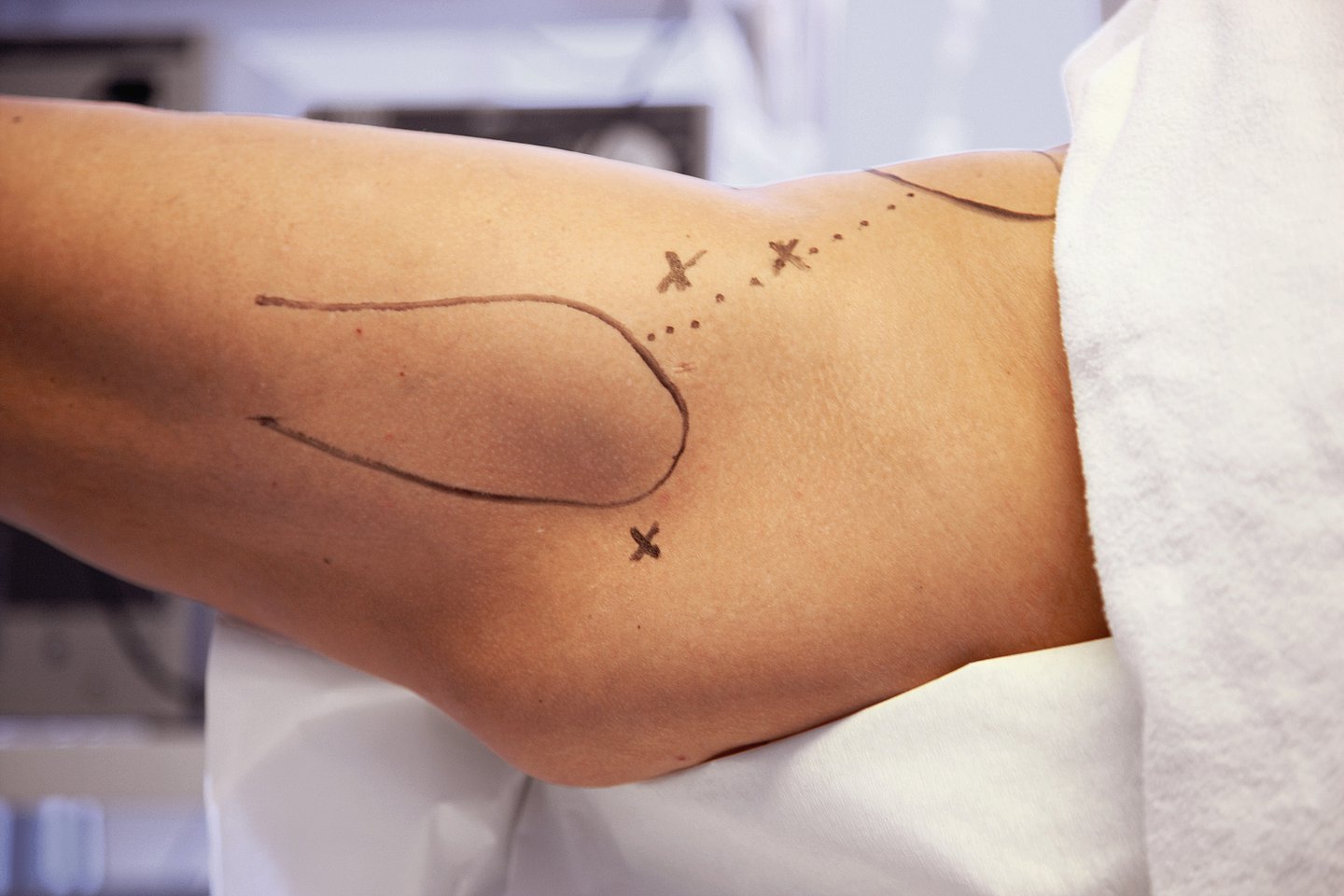 Patientensicherheit Foto: Knie mit Markierungen für eine anstehende Operation.