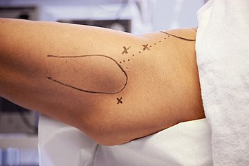 Patientensicherheit Foto: Knie mit Markierungen für eine anstehende Operation.
