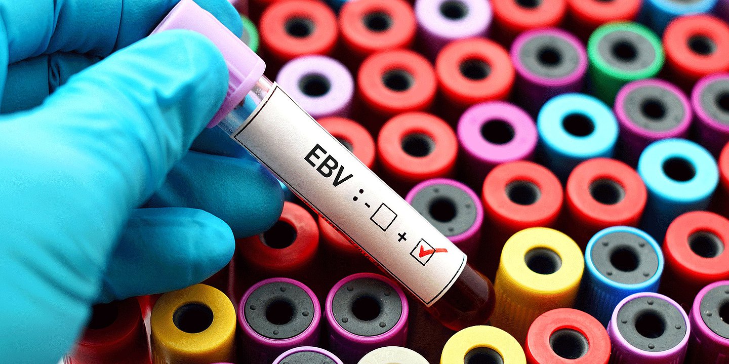 Foto: Eine Hand mit einem Gummihandschuh hält eine Blutprobe auf der "EBV" steht.