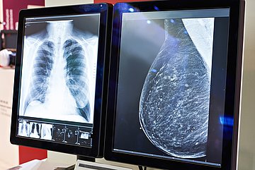 WIdO-Qualitätsmonitor für Schleswig-Holstein Auf zwei Monitoren sind rechts eine Röntgenaufnahme vom Brustkorb und links die Aufnahme einer Brust im Querformat zu sehen.
