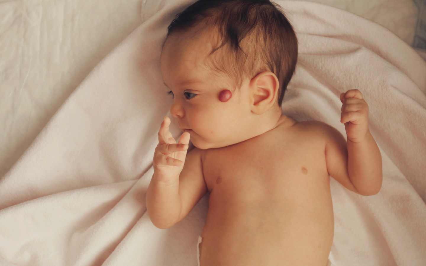 Foto: Säugling mit einem kleinen Blutschwämmchen auf der Wange.
